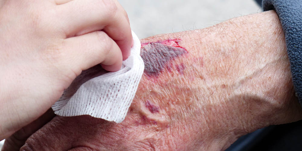 Forflytning uden vævsskader